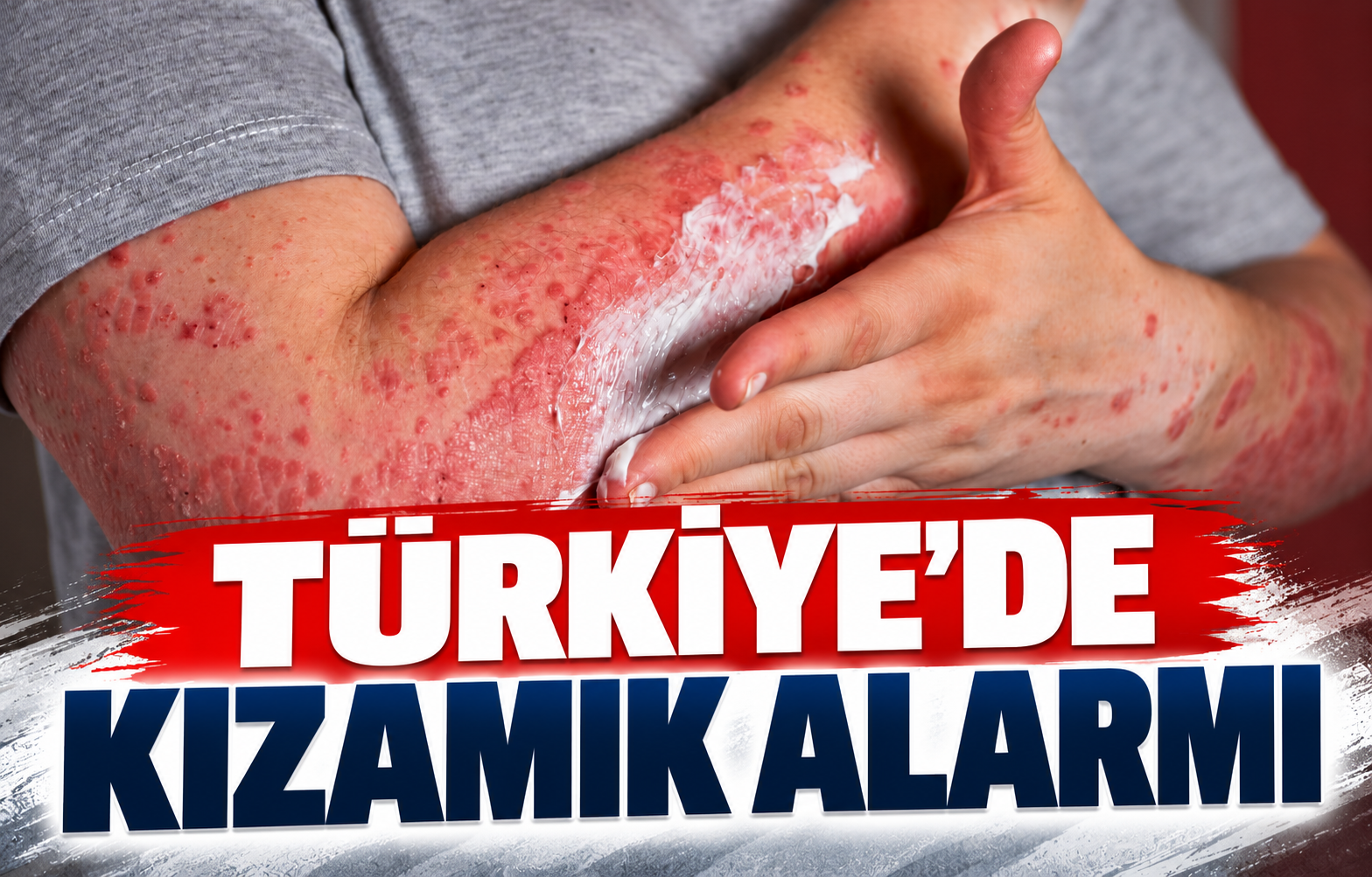 TÜRKİYE'DE KIZAMIK ALARMI